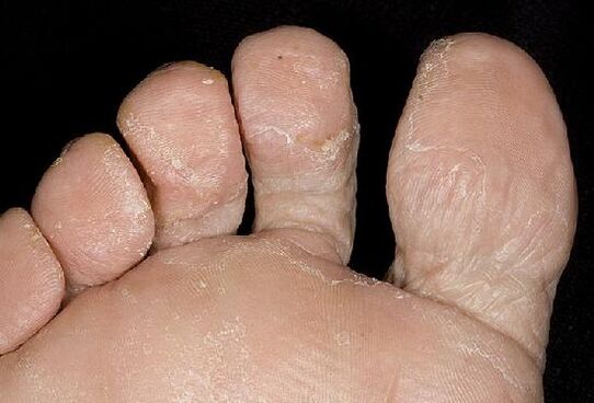 Manifestations of fungal infection on the feet