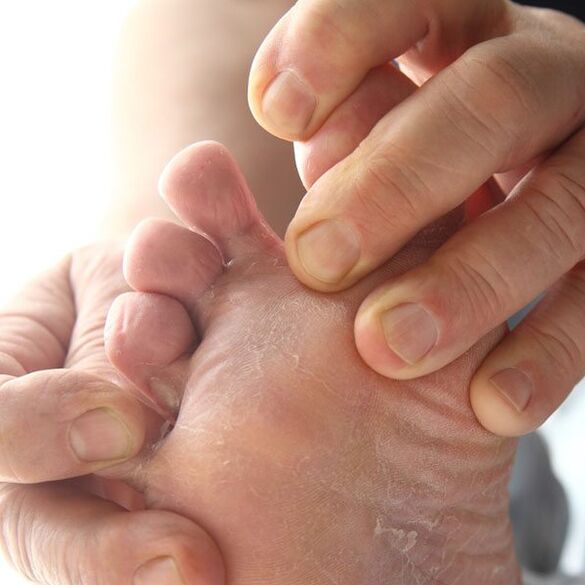 The fungus affects the skin between the toes