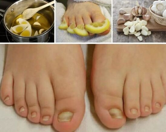 Folk drugs for nail fungus