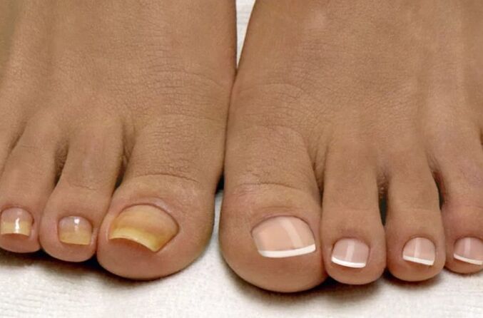 Fungi on your feet