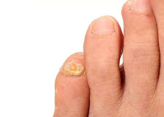 Fungus nail