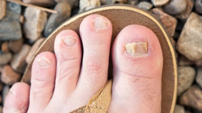Mycosis nails