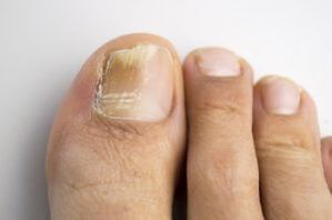Fungi disease