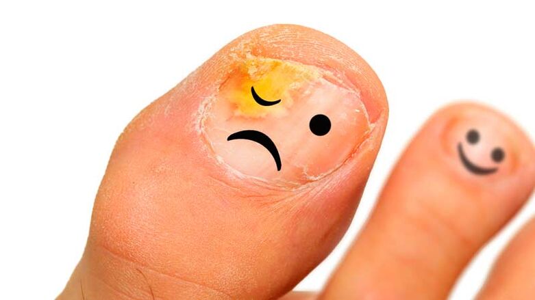 Fungus nail