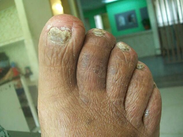 Fungi lesion