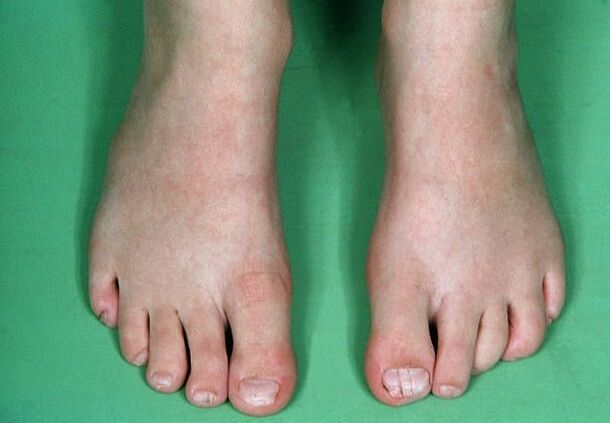 Fungi on your feet