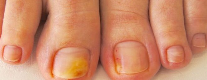 Fungus nail