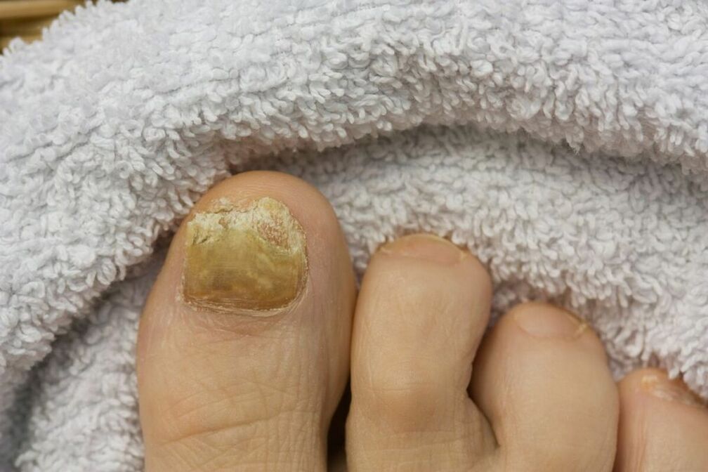 Atrophic stage of the fungus (falling off a piece of toenail)