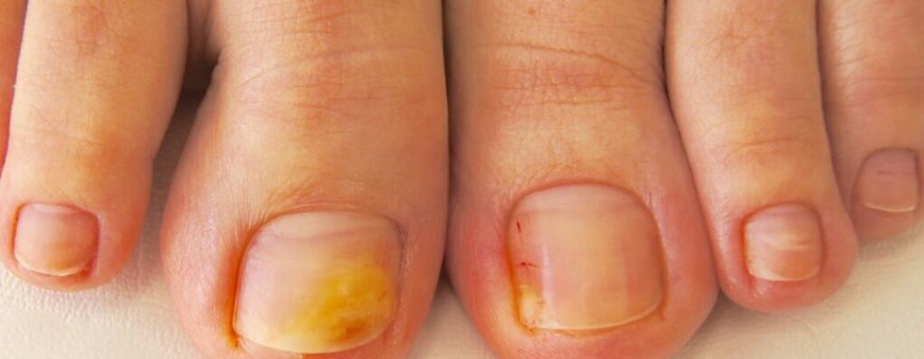 The initial stage of onychomycosis - yellowing of the toenails