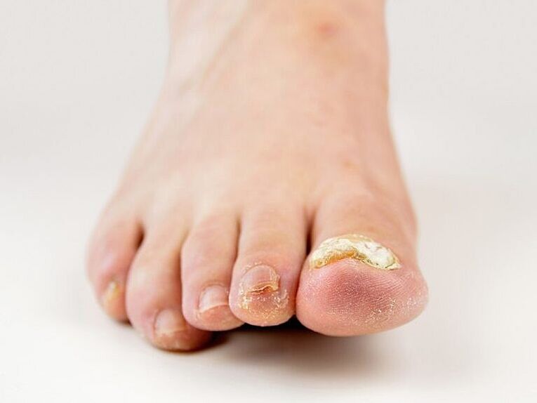 Thickening of the nail plate on the big toe with the fungus