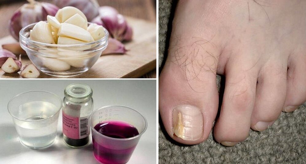 garlic and potassium permanganate against toenail fungus