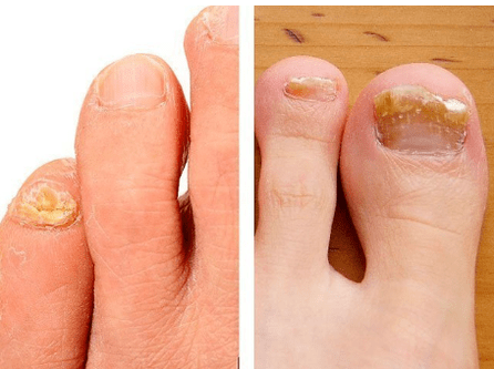 Fungus nail