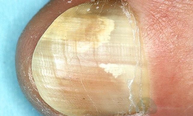 Finger treatment fungus with internal action