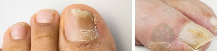 Funny nail thumb on the leg