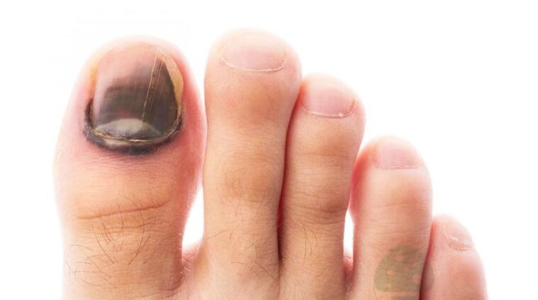 Starting the disease with the fumes of the nail of the thumb