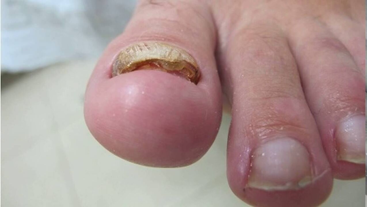 Hypertrophic fungi - deformation of the edges, loss of color and thickening of the nail plate