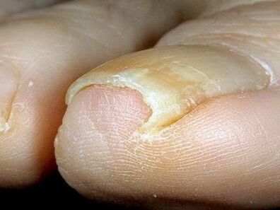 Appearance of toenails infected with fungus