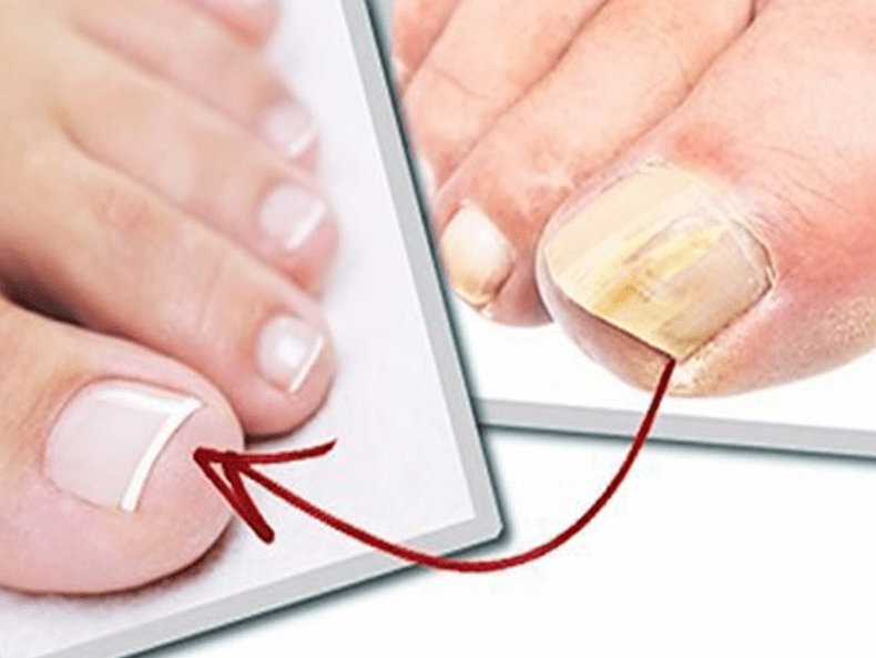 Fungal toenails and healthy nails after home treatment